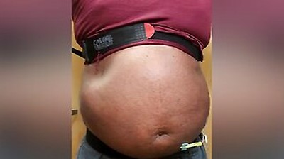 N2o Belly Inflation